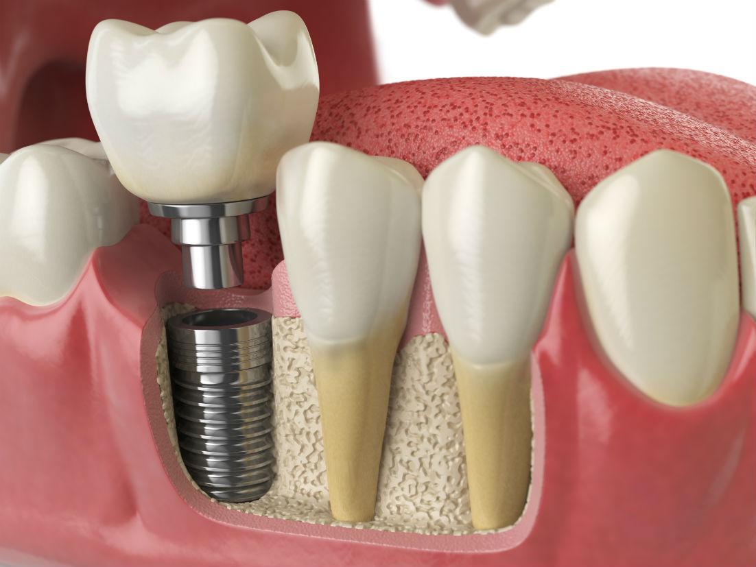 Visalia, CA dental implants